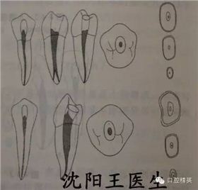 必须了解髓腔解剖和开髓部位寻找根管口必须了解各个牙的根管数目及其