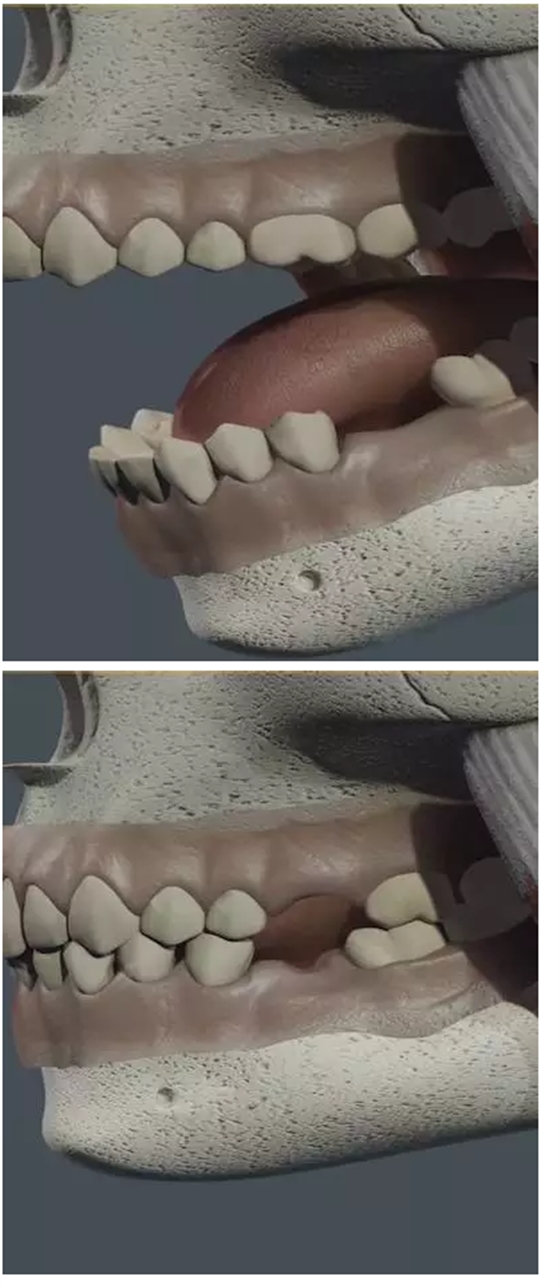 单颗缺牙导致牙列不齐紊乱,致颌或邻牙相继脱落