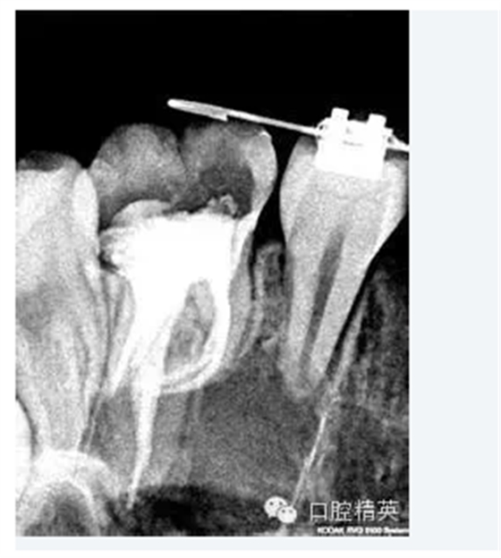 弯曲根管预备的方法和技巧