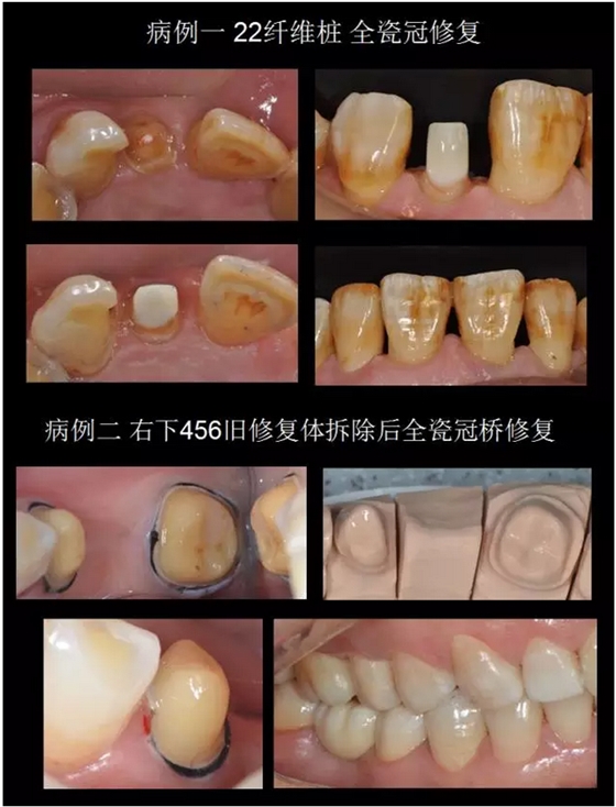 为什么你的牙齿备不好