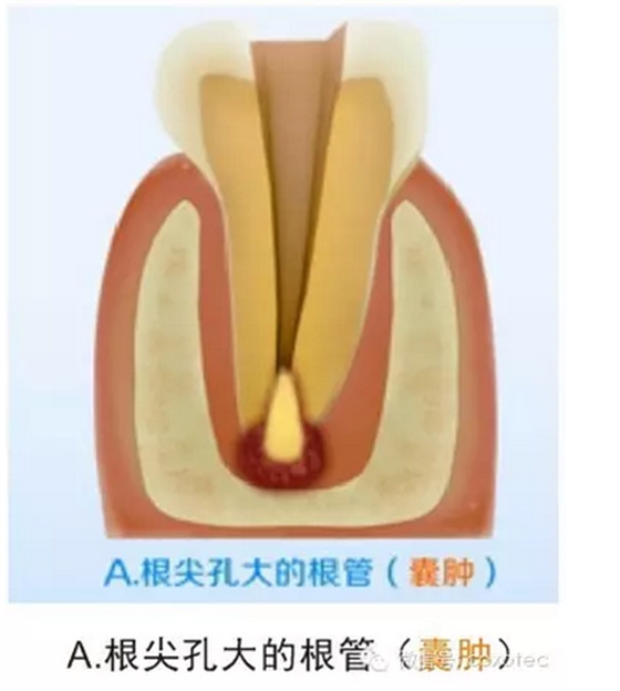 让你知道根管测量受影响的原因