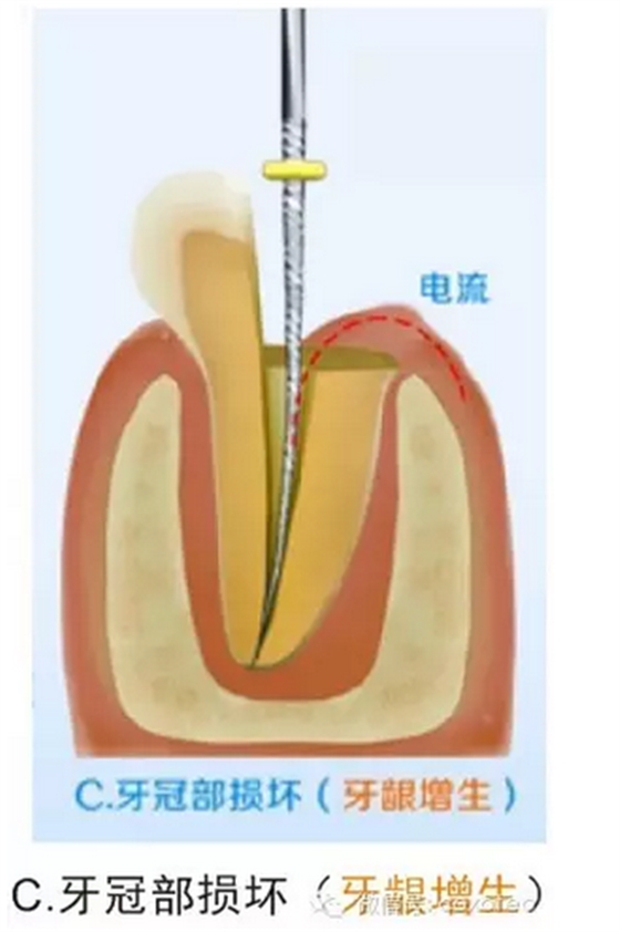 让你知道根管测量受影响的原因