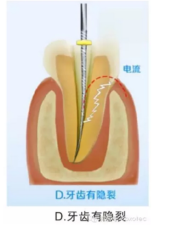 让你知道根管测量受影响的原因