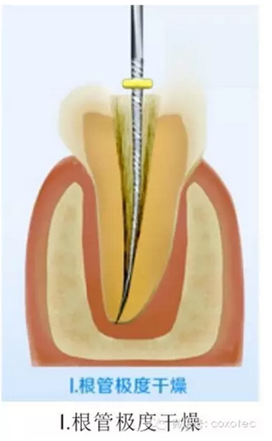 让你知道根管测量受影响的原因