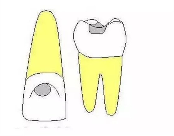 龋齿龋洞的5种类型