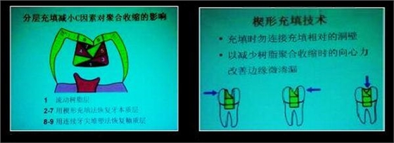 各类牙洞型树脂修复