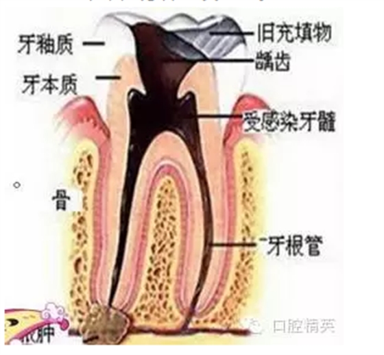 根管治疗