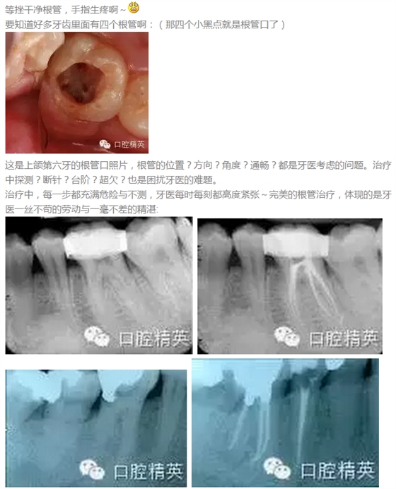 根管治疗