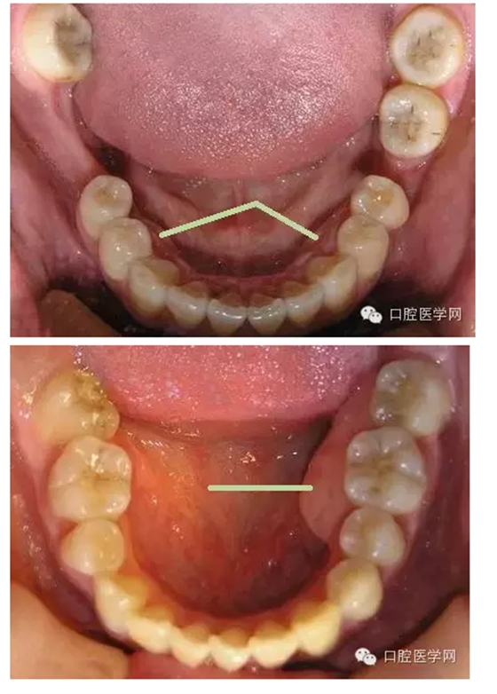 口腔内牙槽骨的骨质增生在临床上比较常见,是指牙龈区域的牙槽骨出现