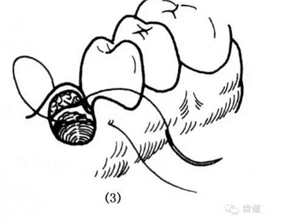 牙医基本技能：口内缝合术（文字、示意图及视频）