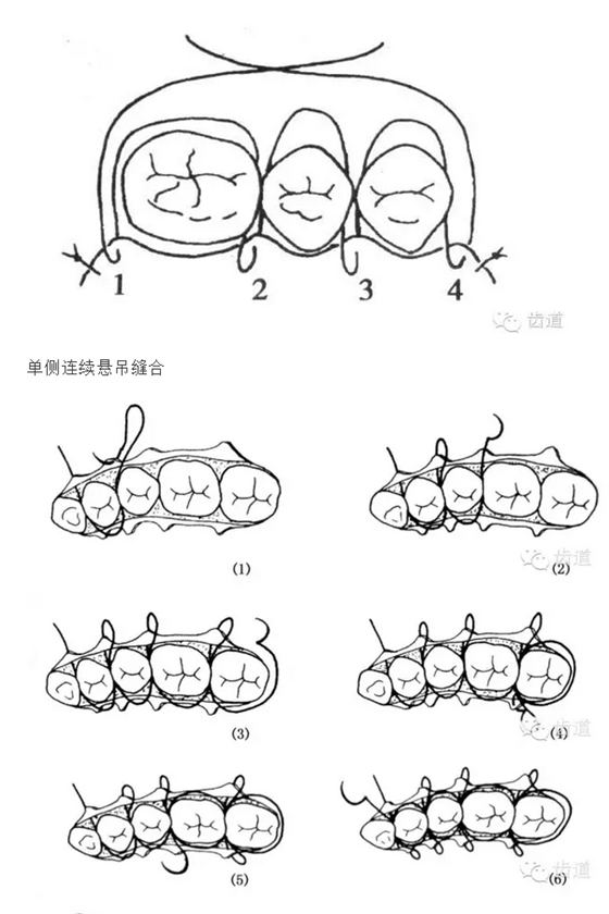 牙医基本技能：口内缝合术（文字、示意图及视频）