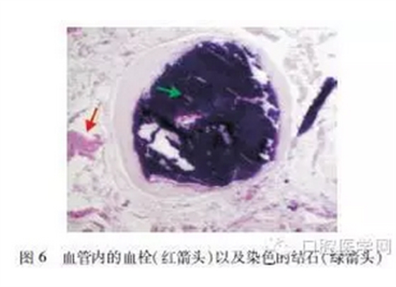 	下颌下静脉畸形伴多发静脉石误诊为涎石病1例