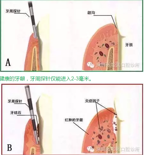刷牙出血，牙龈红肿，并非缺乏维生素