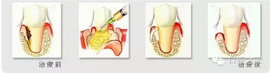 很多看牙周病的患者，不是自己真正意识到这个疾病，主动求诊，而是其他科转诊牙周治疗，尤其是镶牙之前，很多患者需要进行牙周治疗。