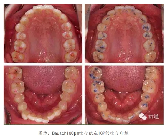 牙科咬合纸的用法