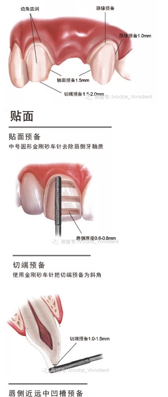 时常搞不清楚怎么备牙吗？义获嘉教您如何完美备牙