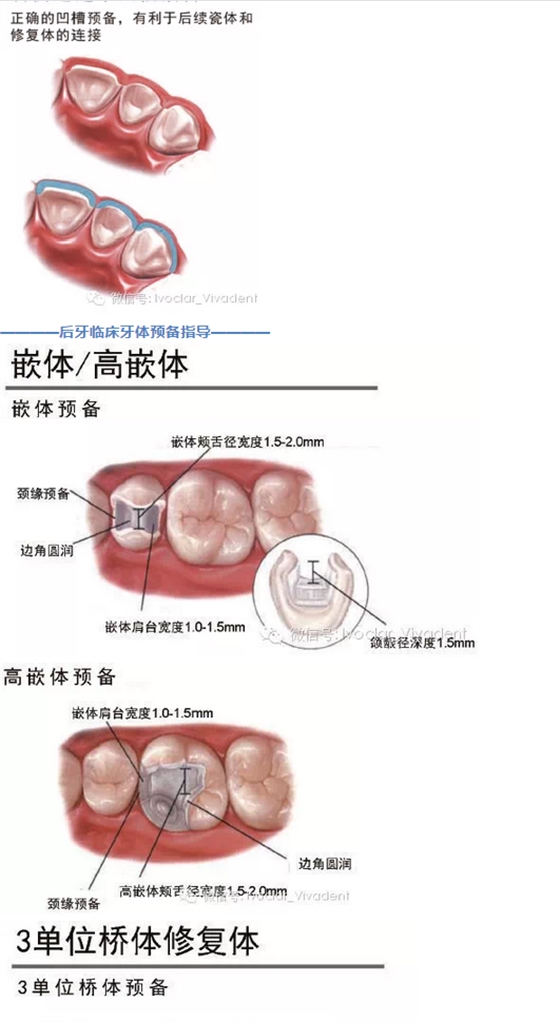 时常搞不清楚怎么备牙吗？义获嘉教您如何完美备牙
