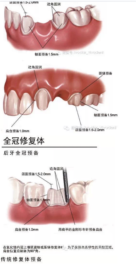 时常搞不清楚怎么备牙吗？义获嘉教您如何完美备牙