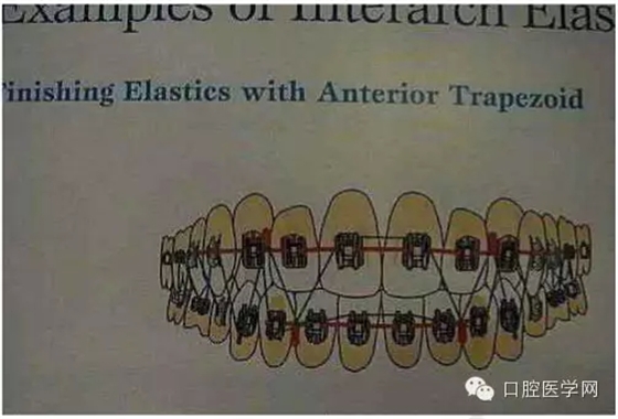 正畸damon system橡皮筋(elastics)挂法示意图