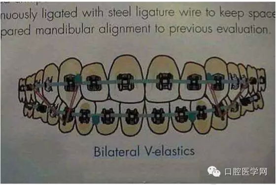 正畸damon system橡皮筋(elastics)挂法示意图