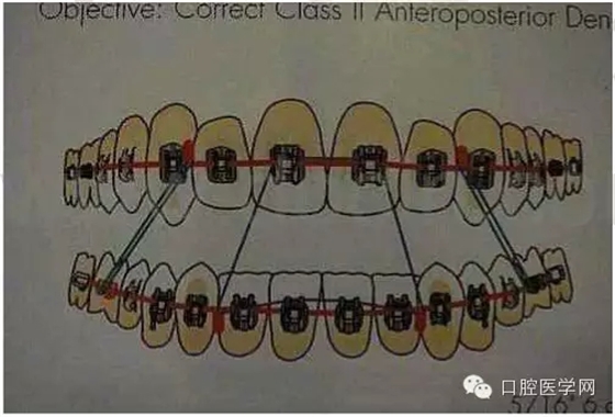 正畸damon system橡皮筋(elastics)挂法示意图