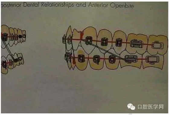 正畸damon system橡皮筋(elastics)挂法示意图