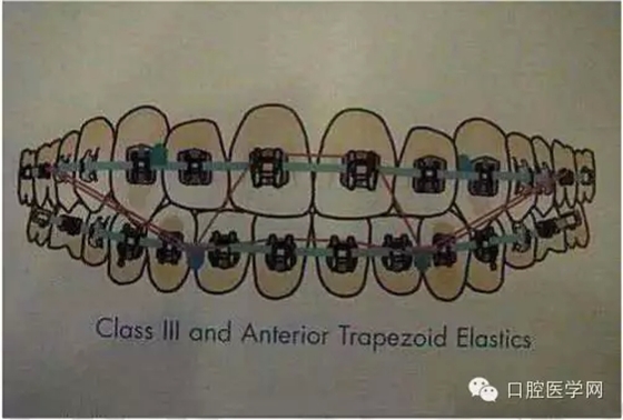 正畸damon system橡皮筋(elastics)挂法示意图