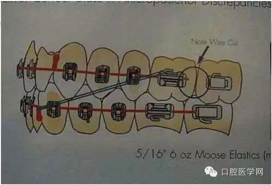 正畸damon system橡皮筋(elastics)挂法示意图