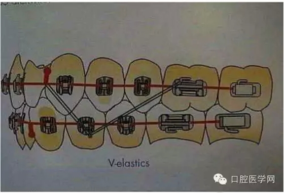 正畸damon system橡皮筋(elastics)挂法示意图