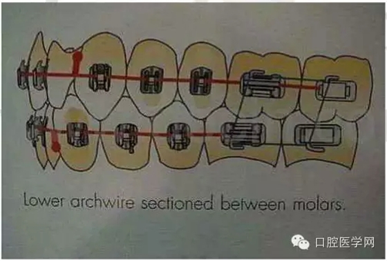 正畸damon system橡皮筋(elastics)挂法示意图