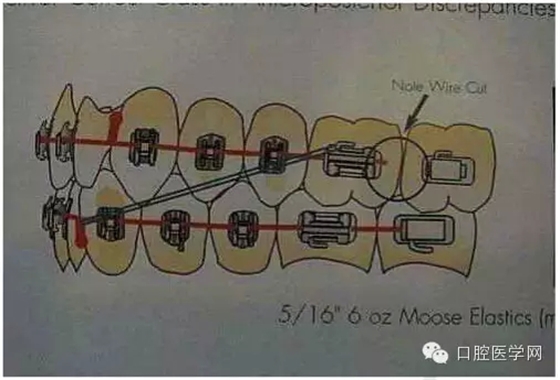 正畸damon system橡皮筋(elastics)挂法示意图