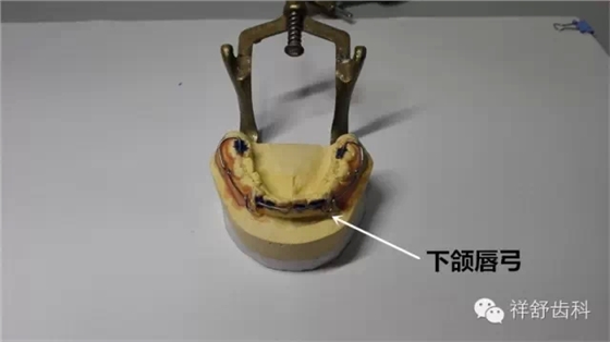 图解Frankel-Ⅲ功能矫治器制作步骤