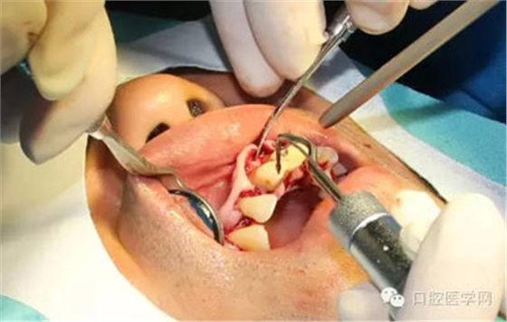 【牙周学习】牙周手术:翻瓣刮治术 gbr