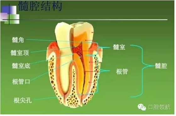 开髓术