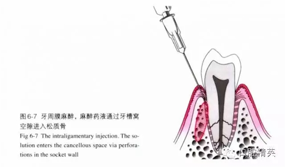 分析局部麻醉失败的常见原因