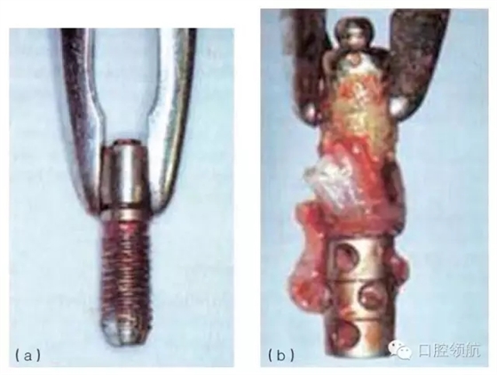 种植体失败的病因和危险因素