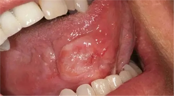 这十种常见口腔疾病，你有遇到过么？