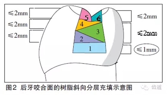 陈智：后牙复合树脂修复技术概述