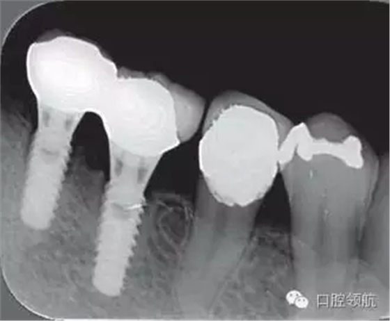 种植体周围出现伴有骨密度增加现象的骨吸收