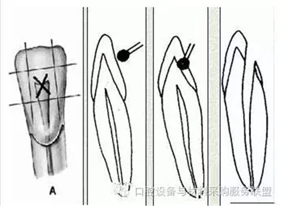 超实用的根管口的探查术