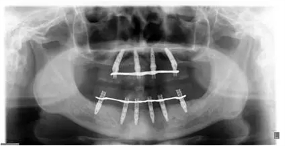 All-on-4上颌种植失败一例及处理方法解析 