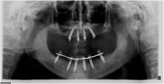 All-on-4上颌种植失败一例及处理方法解析 