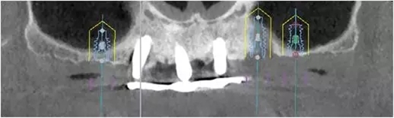 All-on-4上颌种植失败一例及处理方法解析 