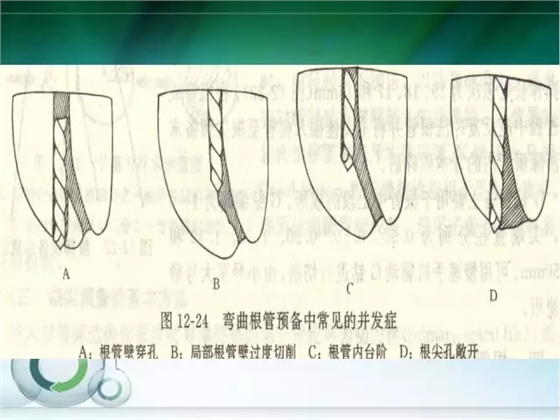 根管治疗并发症及处理