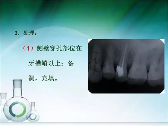 根管治疗并发症及处理