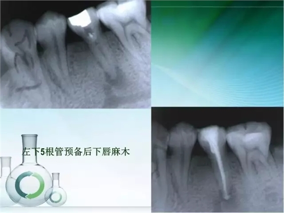 根管治疗并发症及处理
