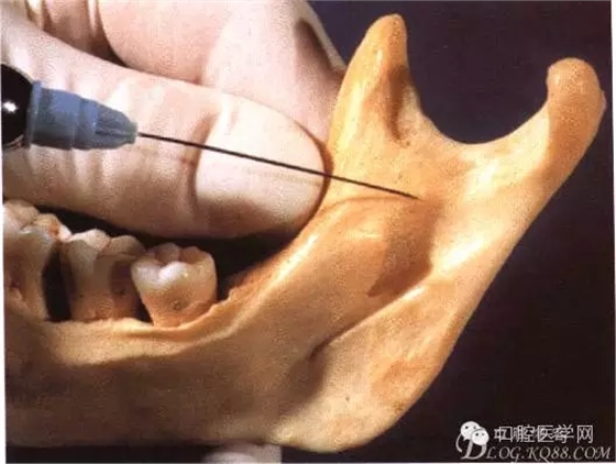 即使是老手也会失手的麻醉----下牙槽、舌、颊一次阻滞麻醉