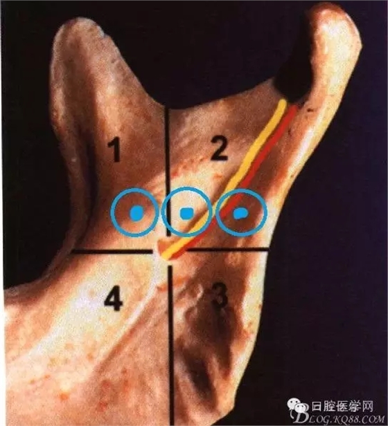 即使是老手也会失手的麻醉----下牙槽、舌、颊一次阻滞麻醉