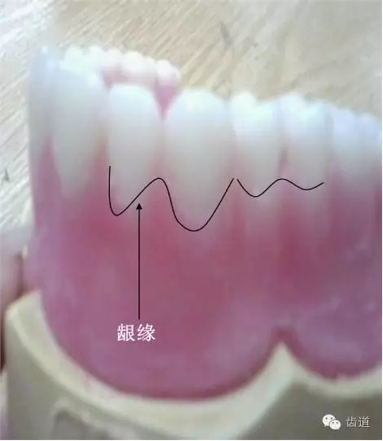 4,龈缘最终用雕蜡器勾勒出形态 5,不能勾的过深,导致牙周病的形态.