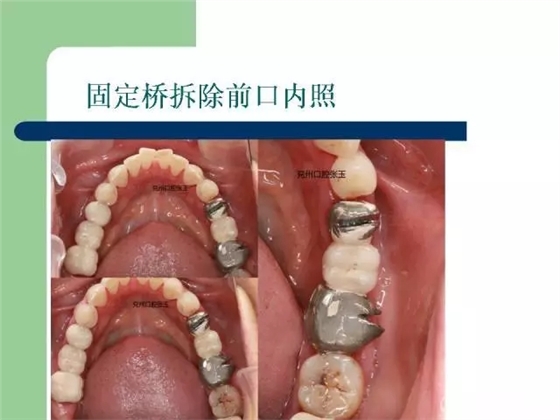 左下后牙不良修复体拆除后重新修复一例